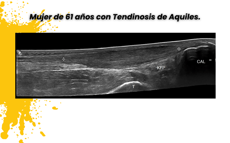 Tend n De Aquiles Y Ecograf a Tempo Formaci n tend-n-de-aquiles-y-ecograf-a-tempo-formaci-n